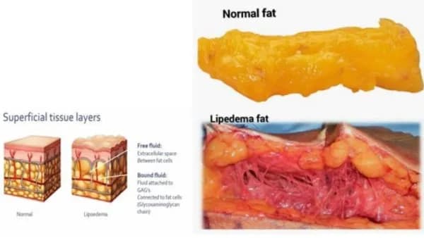 Lipoedema