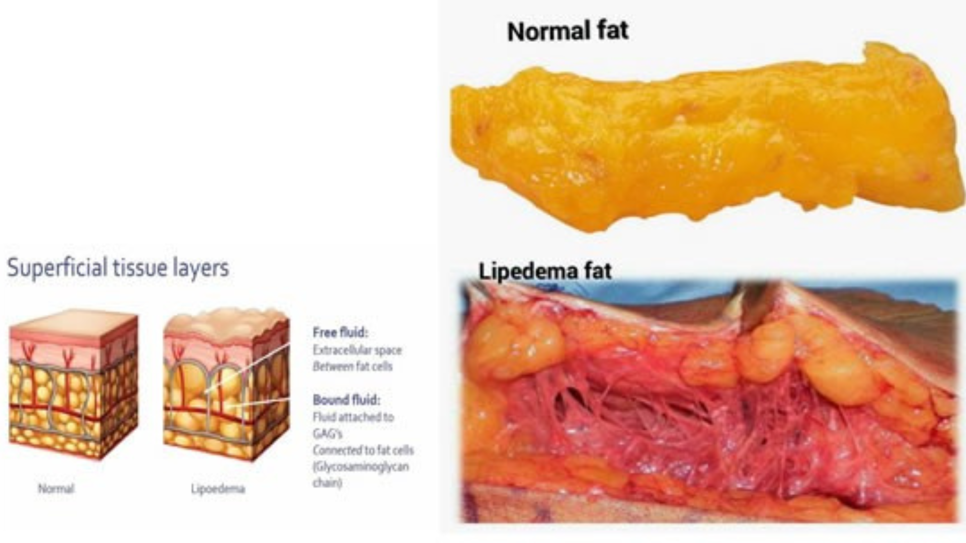 Lipoedema Awareness Month