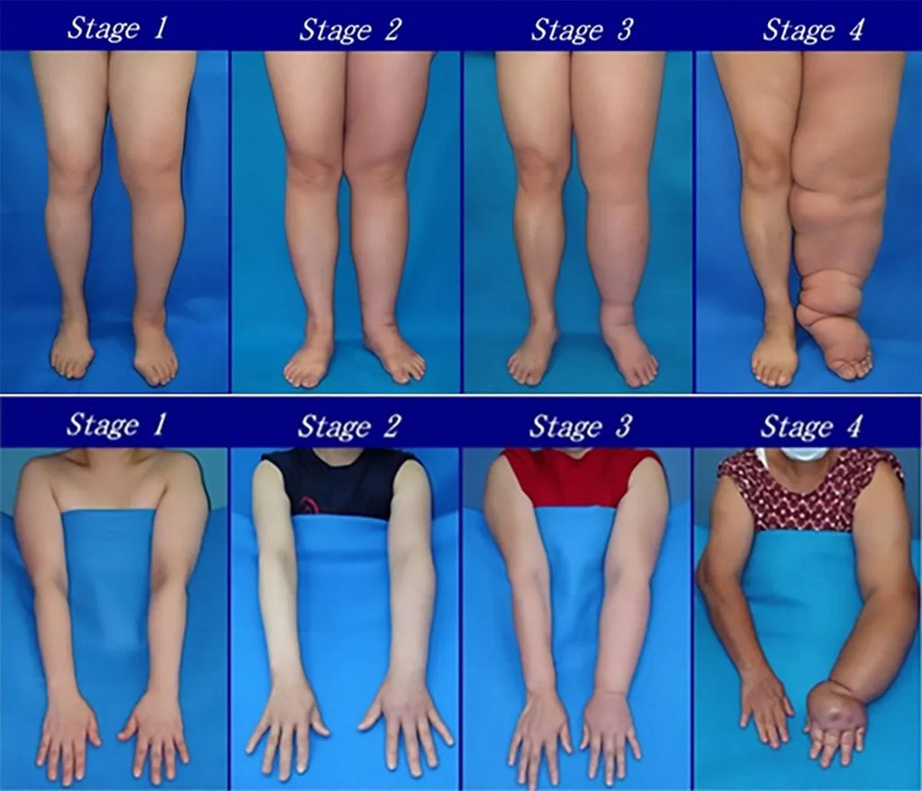 Lymphoedema